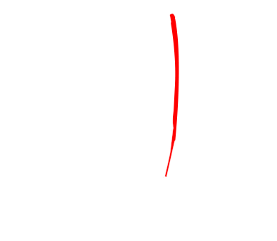 Coronary Artery Bypass